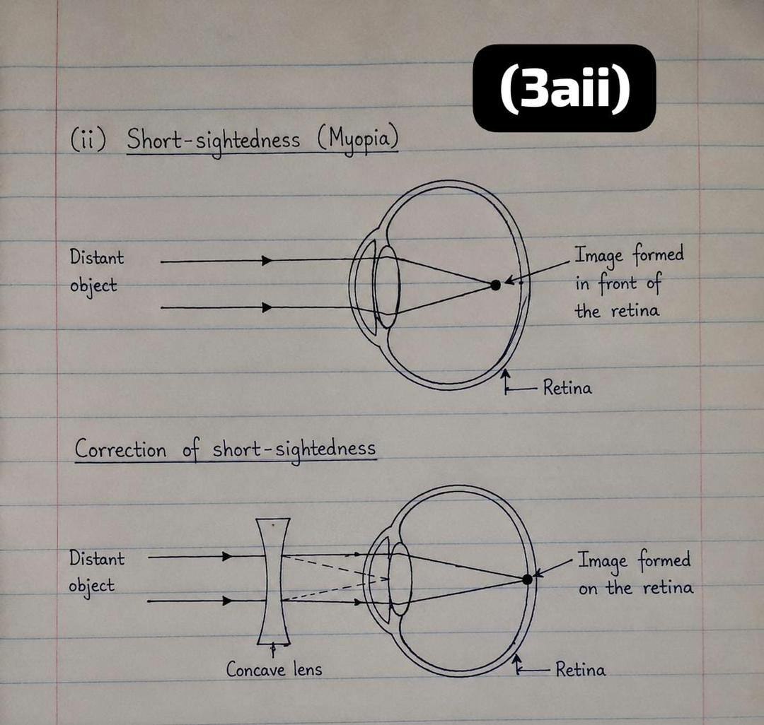 Ray diagram showing short-sightedness (myopia) and its correction with a concave lens